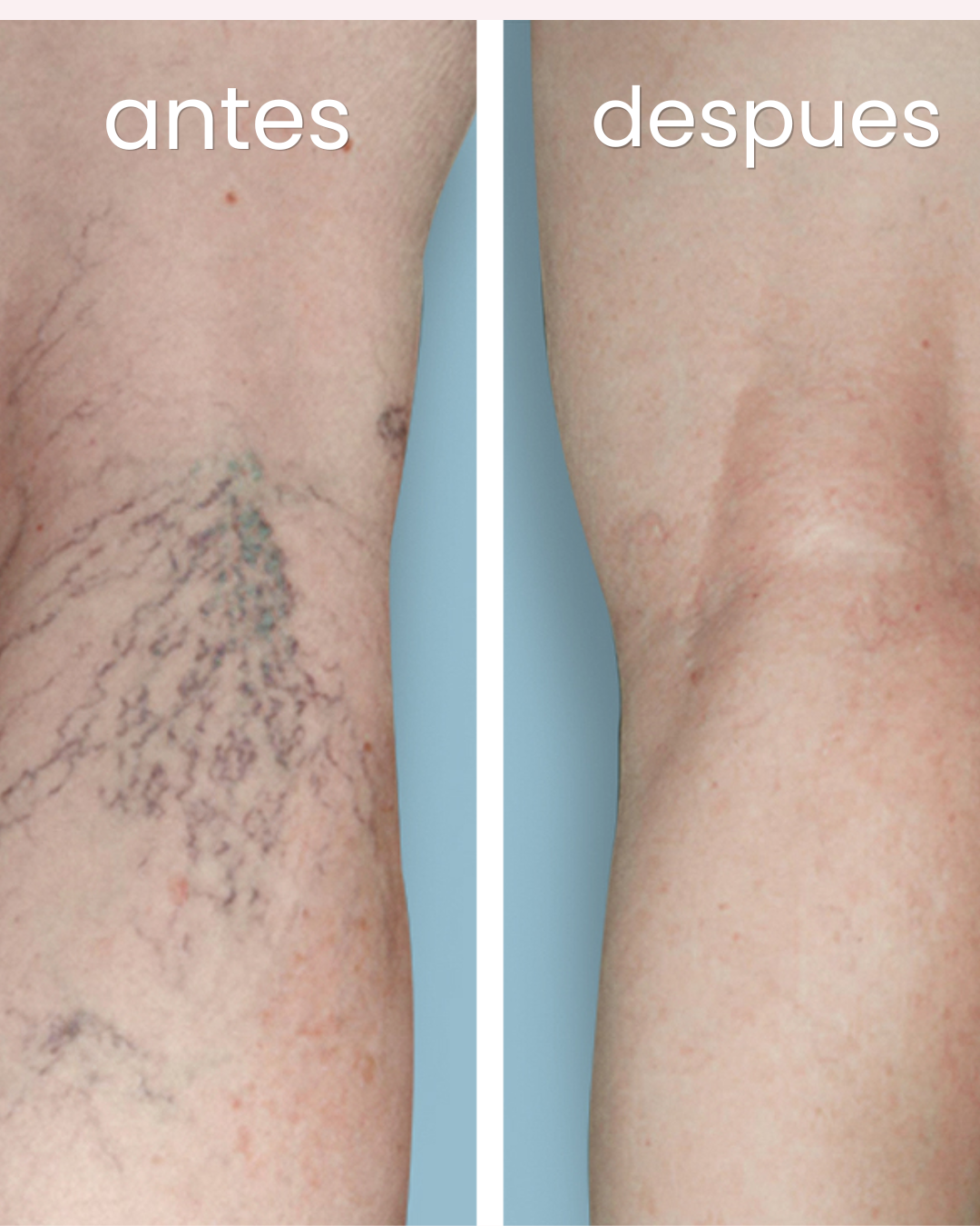 Venastat - Recupera la belleza de tus piernas eliminando las varices