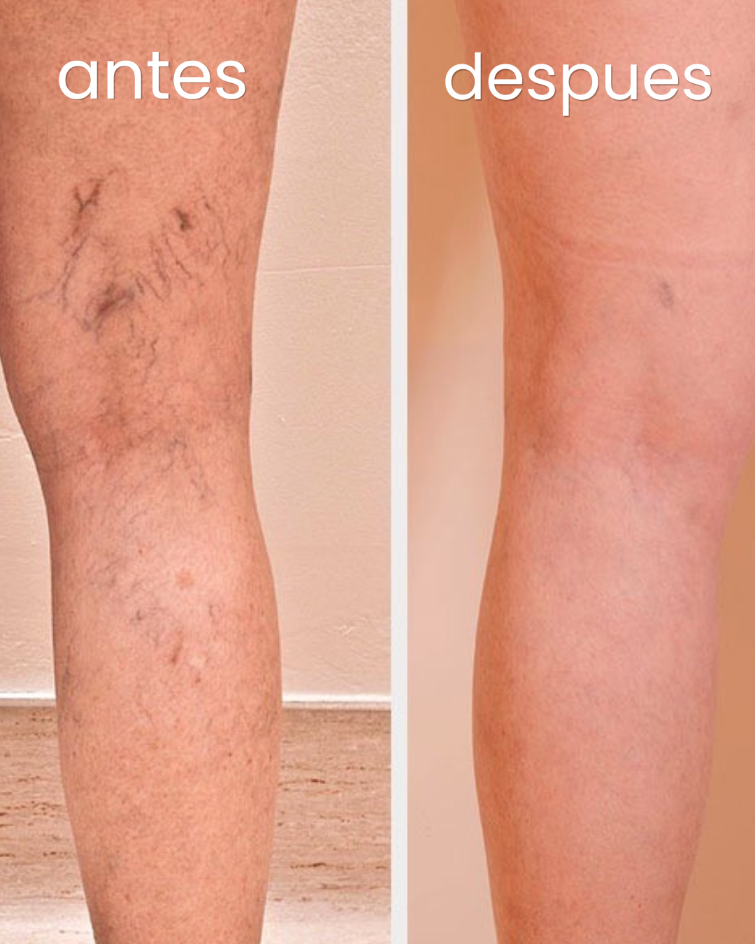 Venastat - Recupera la belleza de tus piernas eliminando las varices
