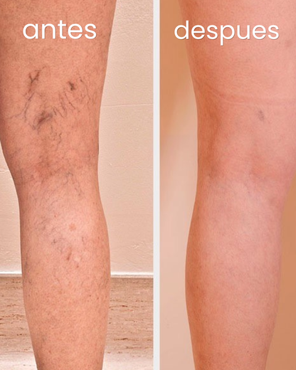 Venastat - Recupera la belleza de tus piernas eliminando las varices